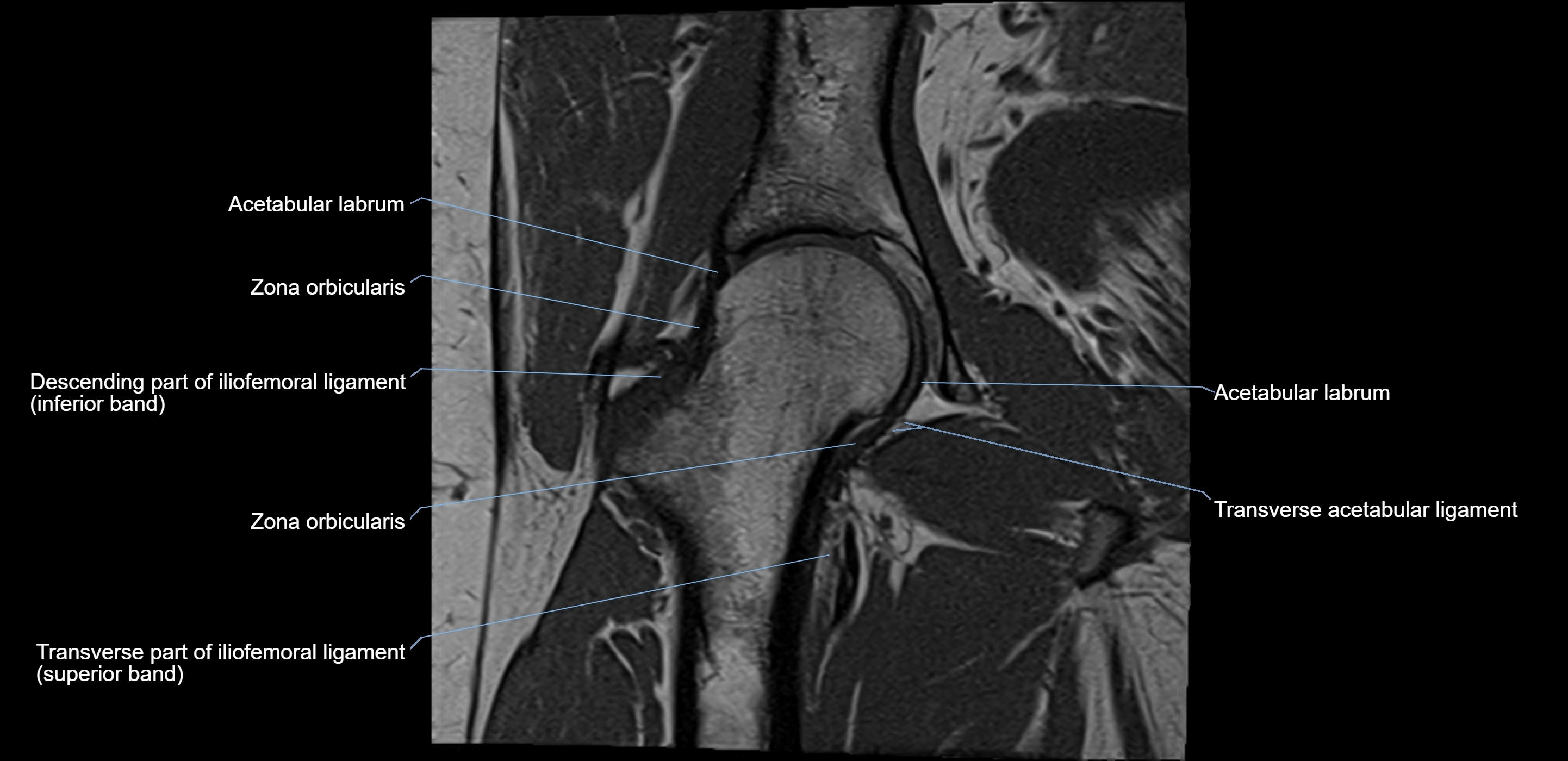 MRI Hip ligaments coronal cross sectional anatomy 3T  radiology  image-img-00001-00012.webp